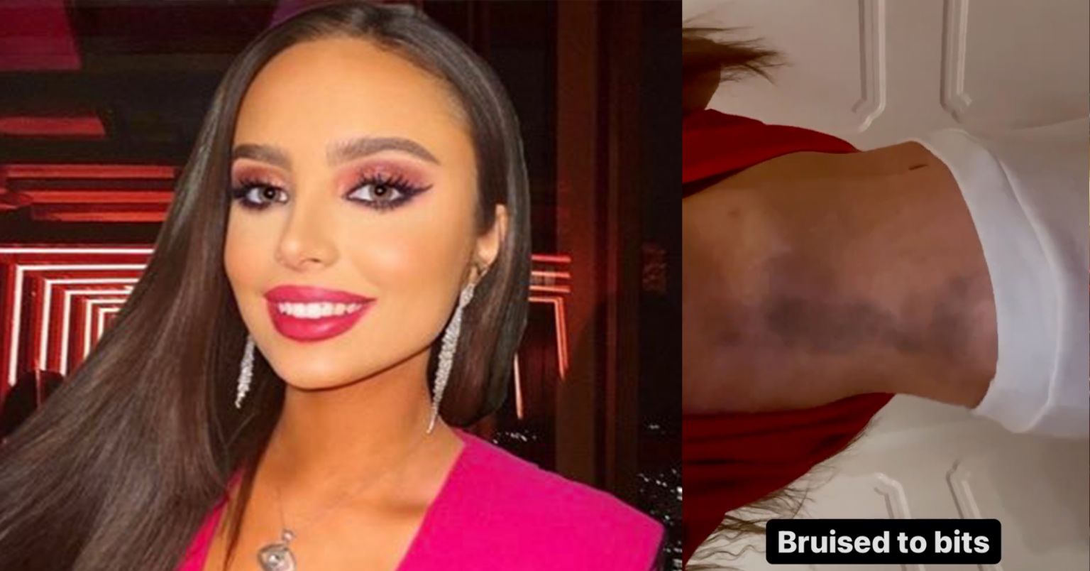 Liverpool Girl Shows Off The Bruises See Got From The Champions League