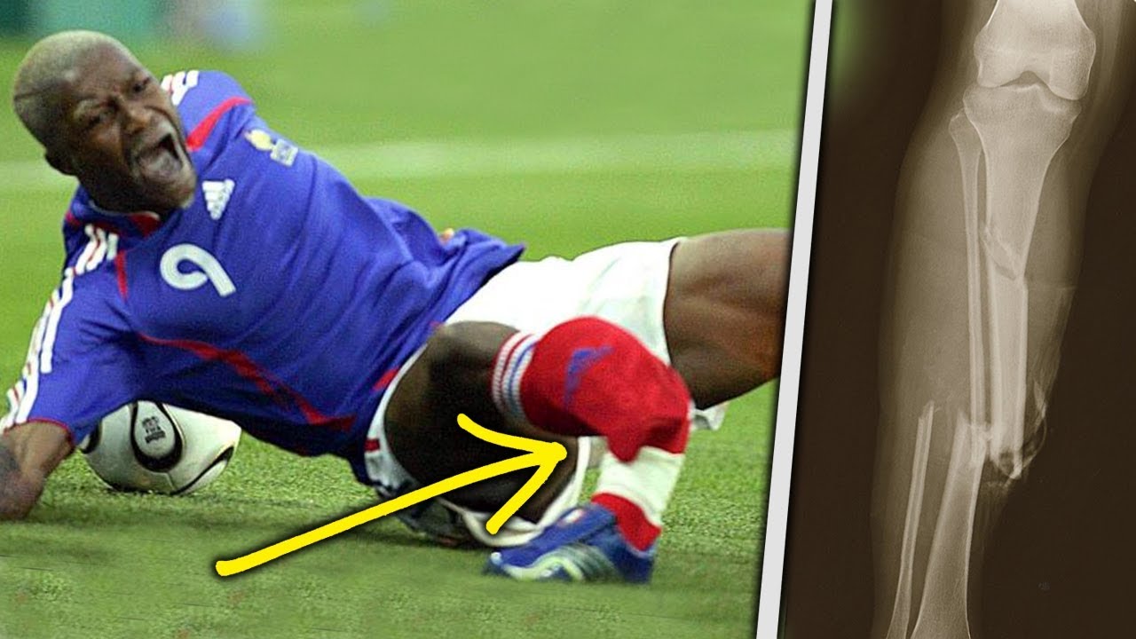 Watch 10 Horrific Injuries That Ruined The World Cup